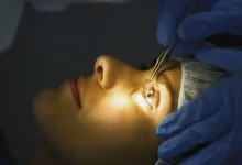 सातधारेमा निःशुल्क तीनदिने आँखा शल्यक्रिया सेवा शिविर सुरु 26 eye surgery